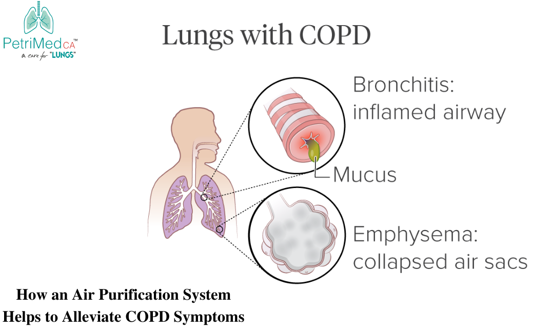 Air Purification System & COPD: How a Fully-Loaded Air  Purification System Can Help People with COPD - PetriMed CA